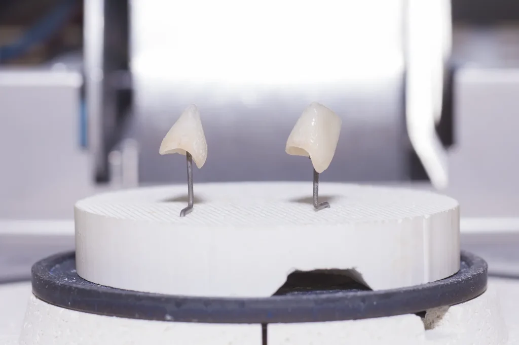 Same-day dental crowns displayed during the fabrication process on a dental model